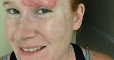Các bác sĩ đã phẫu thuật cấy ghép da từ đùi cho Greenway, tuy nhiên vùng trán của cô vẫn có thể nhìn rõ vết sẹo khá lớn. Ảnh: Caters News Agency.