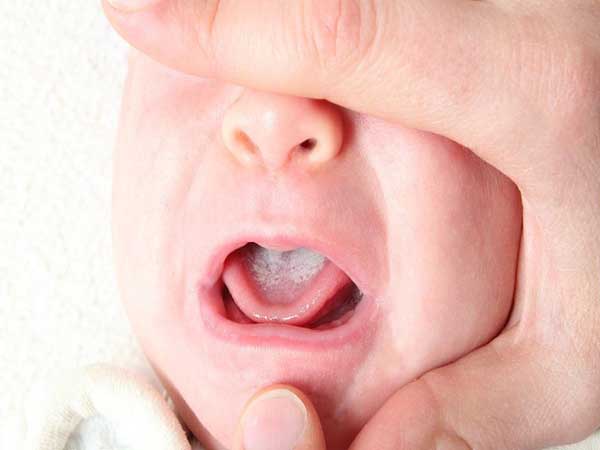 Cách giúp trẻ nhanh khỏi bệnh nấm miệng