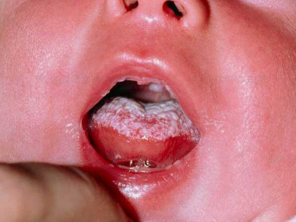 Nấm miệng ở trẻ sơ sinh bao lâu thì khỏi?