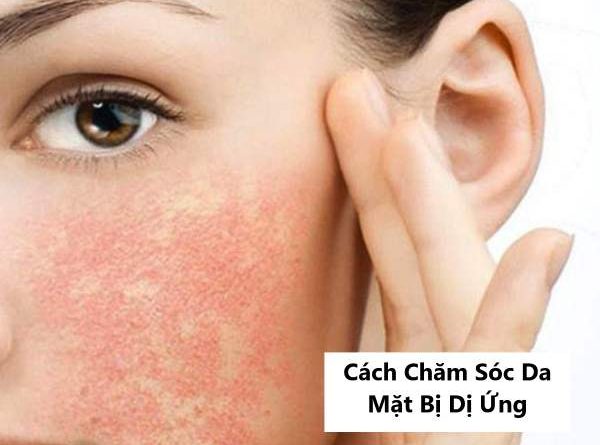 Cách Chăm Sóc Da Mặt Bị Dị Ứng