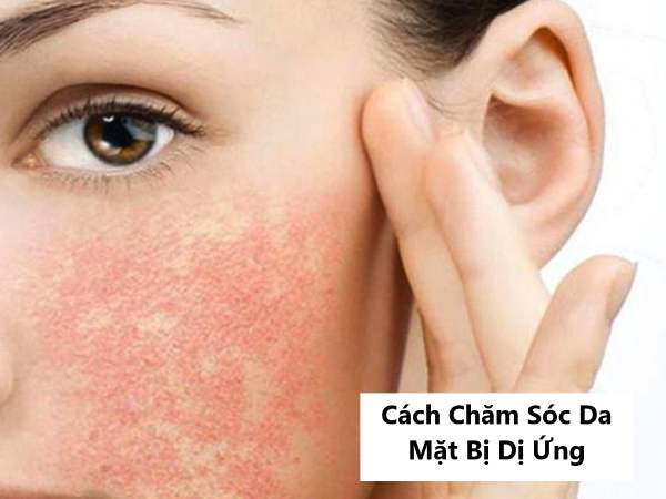 Cách Chăm Sóc Da Mặt Bị Dị Ứng